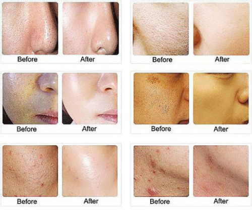 Lactic Acid Skin Peel For Acne Wrinkles Melasma Age Spots